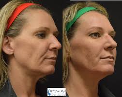 Pin On Injections And Fillers