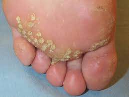 Plantar warts are ugly and uncomfortable. Viral Wart Dermnet Nz