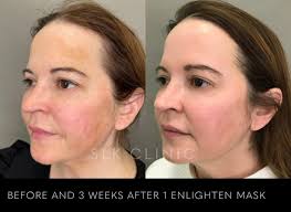 Enlighten Mask: Revitalize Your Skin