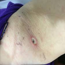 If a bed sore has eschar, a physician may need to remove the dead tissue to classify the wound. Eschar A Clinical Photograph Showing An Erythematous Papule On The Download Scientific Diagram