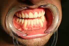 The Pinhole Technique What Hygienists Need To Know Today S Rdh