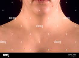 Image result for Webbed Neck