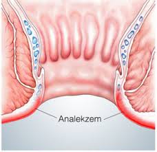 Analekzem Symptome Und Behandlung Phytodoc