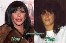 To revisit this article, visit my profile, thenview saved stories. Big Ang Plastic Surgery Before After Pictures