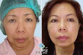Full Face lift