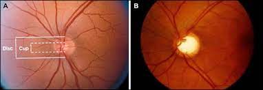 The optic nerve is composed of approximately 1.5 million axons that connect the retina to the visual targets in the brain. Emerging Concepts In Glaucoma And Review Of The Literature The American Journal Of Medicine