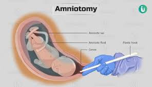 Image result for Amniotomy