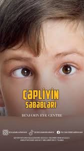 Çəpliyin səbəbləri. , 👁️Uzm Dr Benjamin Karimov, 📲050-822-22-20,  📲050-822-22-21 , #qlaukomaemeliyyatı , #qlaukomamüalicesi, #qlaukoma  #qarasu #gözhəkimi #gozhekimi #oftalmoloq #oftalmoloqcerrah ...