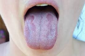Image result for mouth ulcer on tongue)