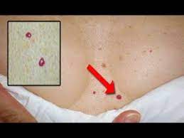 Cherry angiomas, also known as campbell de morgan spots or senile angiomas, are cherry red papules on the skin. Cherry Angioma Removal Hemangioma Campbell De Morgan Youtube Skin Spots Alcohol Ink Crafts Cherry Angioma Removal