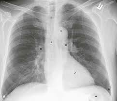 • identify cardiothoracic anatomical structures demonstrable on a chest film. The Normal Chest X Ray Reading Like The Pros Thoracic Key