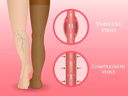 Compression Stockings For Pregnant Mothers Preemie Twins Baby Blog
