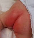 Diaper Rash Treatment, Cream Home Remedies - eMedicineHealth