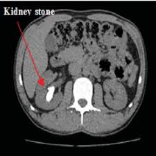 An Image Preprocessing Method For Kidney Stone Segmentation In Ct Scan Images Semantic Scholar
