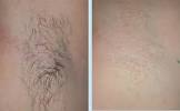 1 4 Inch Brazilian Wax Hair Length