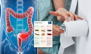 The symptoms of bowel cancer can include: Bowel Cancer Symptoms Signs Of A Tumour Include Red Blood In Poo Express Co Uk