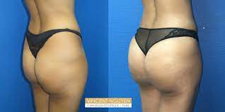 Lipofilling fesses tunisie, augmentation du volume des fessiers par réinjection de graisse autologue. Lipofilling Fessier Ou Des Fesses Lifting Bresilien Paris