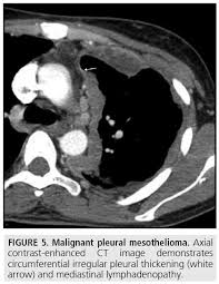 Malignant peritoneal mesothelioma is an uncommon primary tumor of the peritoneal lining. Diagnostic Imaging And Workup Of Malignant Pleural Mesothelioma