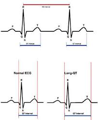 Image result for QT Interval