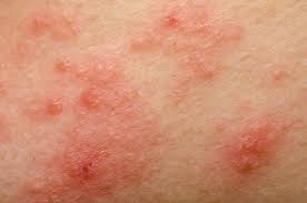 Image result for dermatitis contacta allergica