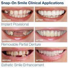 • asia's amazon for photography beta • photographers in 58+ cities • $5/booking for our impact. The Original Clip On Smile Instant Smile Veneer Outletizer
