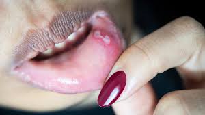 Cabut gigi geraham bongsu | wisdom tooth removal. Heran Kok Bisa Sariawan Muncul Setelah Cabut Gigi