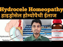 Maybe you would like to learn more about one of these? Hydrocele Homeopathic Medicine In Hindi à¤¹ à¤‡à¤¡ à¤° à¤¸ à¤² à¤• à¤¹ à¤® à¤¯ à¤ª à¤¥ à¤• à¤¦ à¤µ The Mahafuzur Homeopathy Youtube