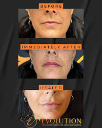 Check out these lips done by our nurse injector, Heather! Stunning results  every time! 💋🤩 #lipfiller #nurseinjector #beforeandafter #overlandpark  #medclinic #aesthetics #braun