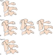Image result for Subaxial Injury Classification Scale