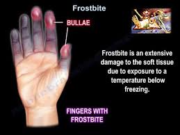 Image result for Frostbite