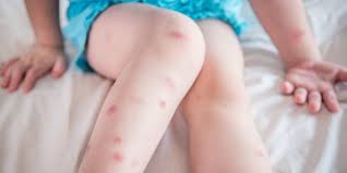 Picada de mosquito | Prevenir, aliviar comichão e reduzir marcas - a pele  que habito