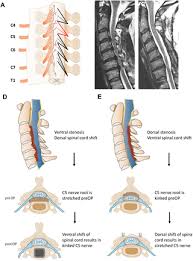 Limitation of motion in the spine Impact Of The Surgical Strategy On The Incidence Of C5 Nerve Root Palsy In Decompressive Cervical Surgery