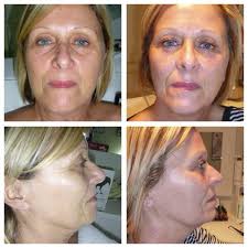 Caci Non Surgical Facelift Before And After Pics Caci Ultimate Nonsurgicalsolutions Non Surgical Facelift Facelift Before And After Facial Before And After