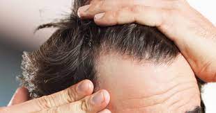 Rambut yang sihat, lebat dan berkilau dengan pemilihan gaya rambut yang tepat akan meningkatkan nilai kejelitaan seseorang. Orang Lelaki Elak Gayakan Rambut Dengan Kerap Boleh Botak Di Awal Usia Keluarga