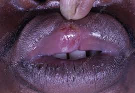 Image result for syphilis ulcer