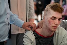 Ukrainian teen receives helps with burn ...