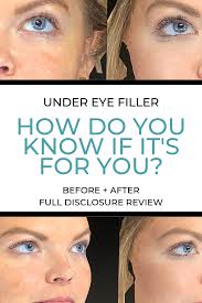 Under eye filler before and after. Should You Get Under Eye Filler Beauty The Glitter Gospel