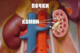 Dieta Pri Kamnyah V Pochkah Sovety Urologov V Uclinica