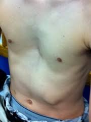 Post the definition of pectus to facebook share the definition of pectus on twitter. Pectus Excavatum Children S Hospital Of Philadelphia