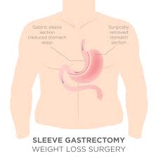 Gastric sleeve surgery doesn't mean you'll always lose weight, sometimes the weight loss will be hampered by numerous factors. Top 3 Things That Will Surprise You About Gastric Sleeve Surgery Birmingham Minimally Invasive Surgery