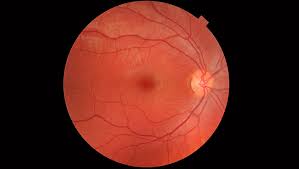 macular degeneration searching for a treatment