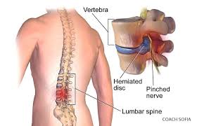 While a number of ways exist to release and stretch these key posture muscles, the most important thing is that you do at least some of them regularly. How To Fix Lower Back Pain When Bending Over Instant Fix