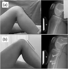 Image result for PCL Sag Test
