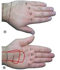 Image result for Normal Anatomic Position of the Hand and Wrist
