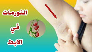 الغدد اللمفاوية في الابط أسبابها و لماذا يجب الحذر منها Youtube