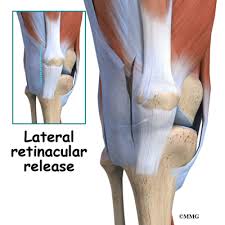 Check spelling or type a new query. Bipartite Patella Eorthopod Com