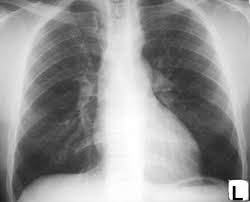 File:COA x-ray.jpg - wikidoc