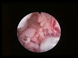 Resultado de imagen para adenocarcinoma endocervical primario  HISTEROSCOPIA