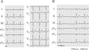 Sick Sinus Syndrome Induced By Interferon And Ribavirin Therapy In A Patient With Chronic Hepatitis C Journal Of Cardiology Cases