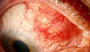 Image result for Scleritis